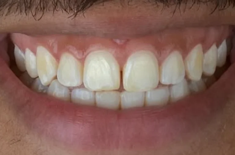 gengivoplastia e lente - antes