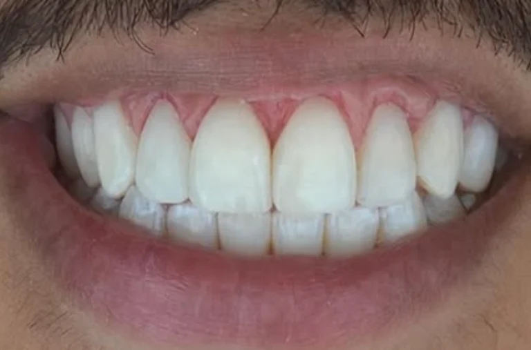 gengivoplastia e lente - depois