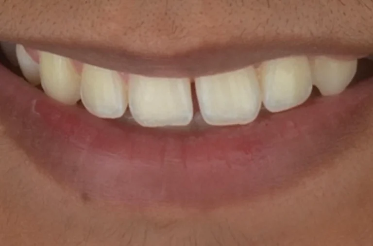 ortodontia-lentes antes